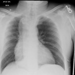 AP chest xray wide mediastinum