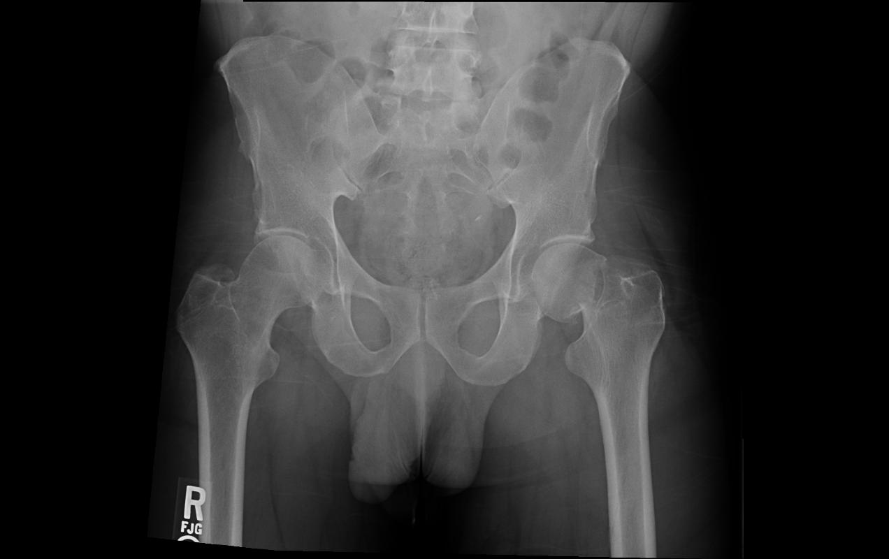 Rehabilitation Program For Femur Fracture