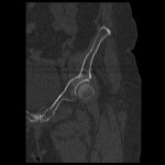 pubic ramus fracture