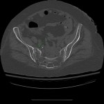 sacral fracture