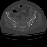 fracture sacrum