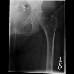 hip pelvic fracture