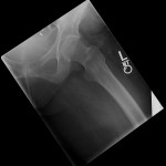pubic ramus fracture