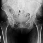 pelvic fracture